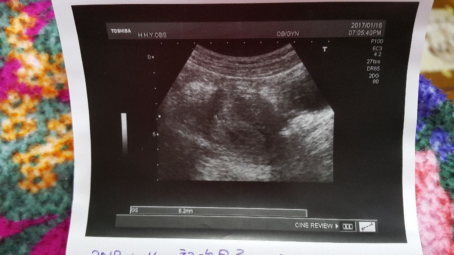 懷孕五週胚囊0 8公分又出血 Babyhome親子討論區