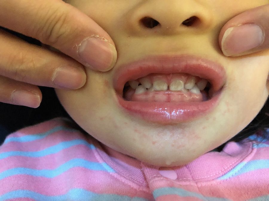 儿童牙菌斑早期图片图片